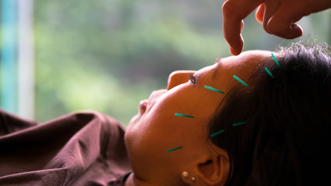Treating Sleep Paralysis With Acupuncture Treating Sleep Paralysis With Acupuncture